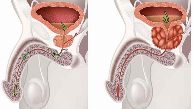 Stagnatioun vum Urin iwwer Prostatitis