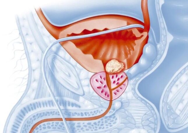 Features vun chronescher Prostatitis